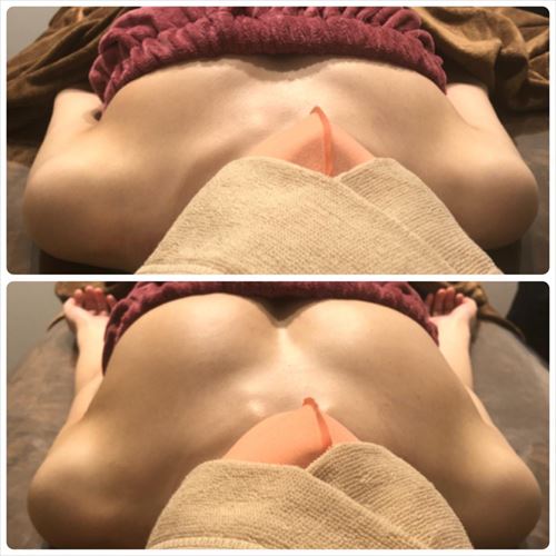 バストアップサロンの施術で変化した胸のビフォーアフター画像
